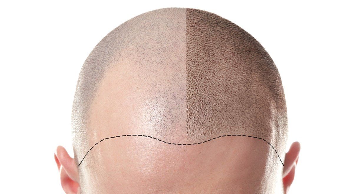 Scalp tricopigmentation treatment