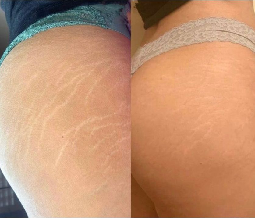 Stretch Marks Camouflage