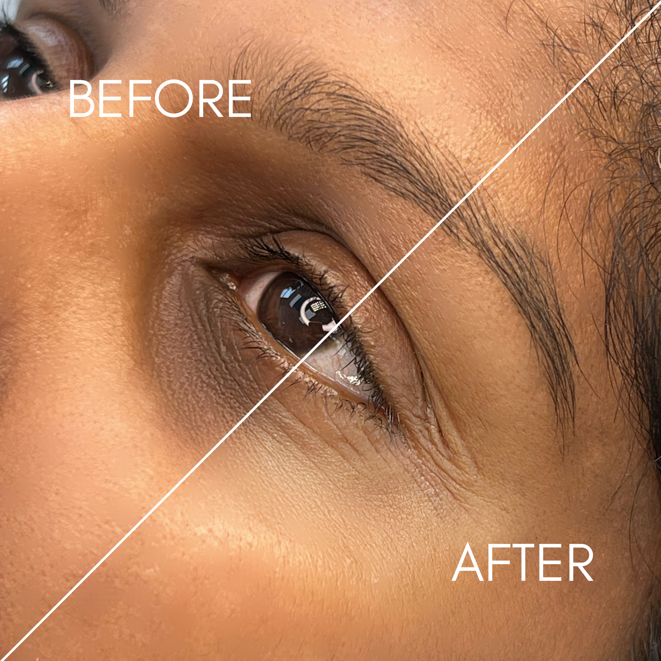 Before and After Dark Circles Correction
