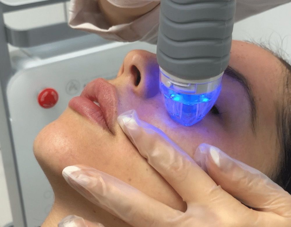 Fractional RF Microneedling