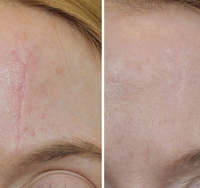 Scar Camouflage Edmonton