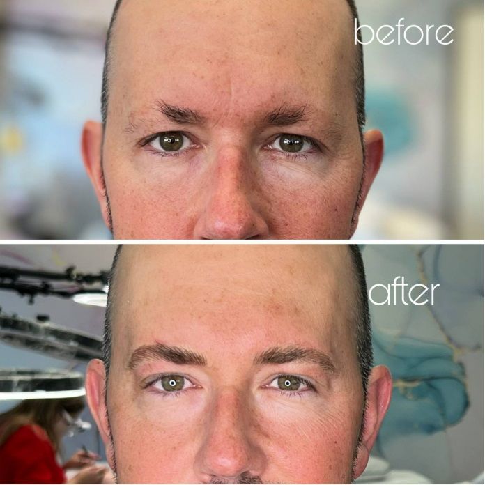 Nanoblanding for men before and after