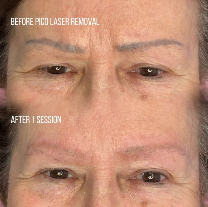 Before and after Pico Laser Removal