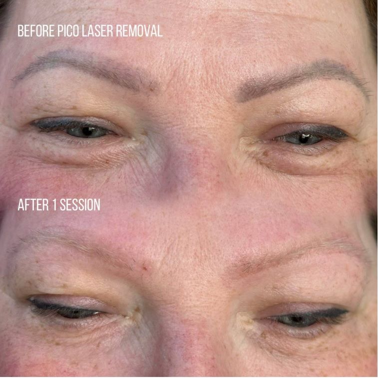 Pico Laser Removal