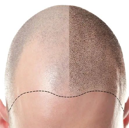 Scalp Tricopigmentation (SMP)