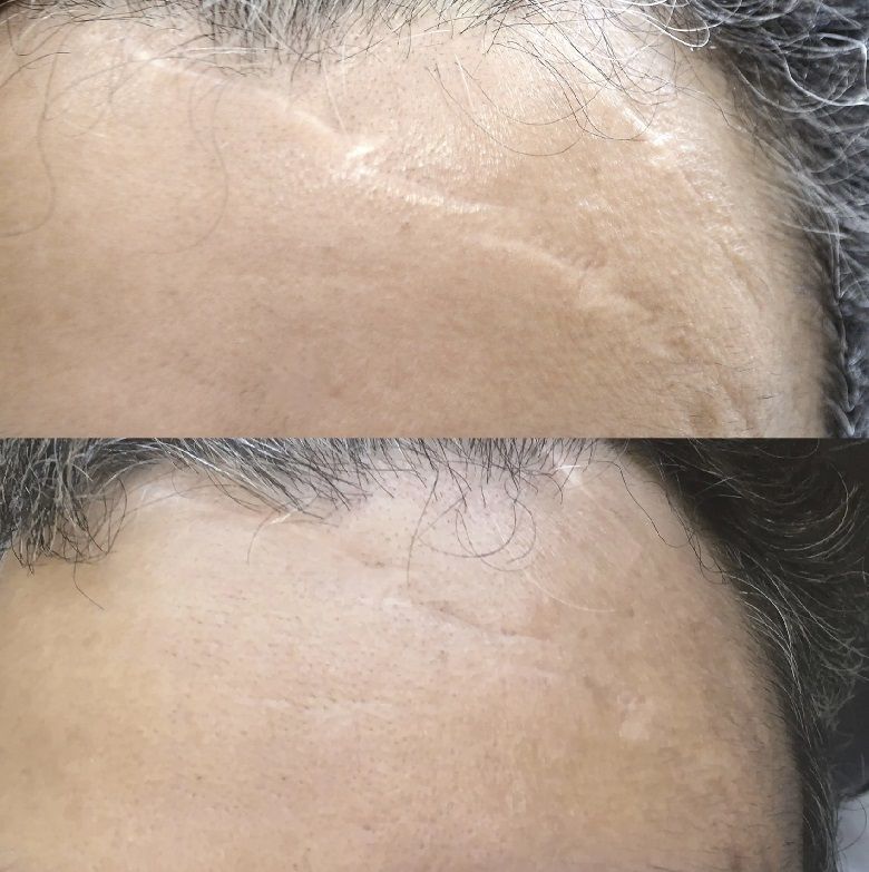 Scar Reduction