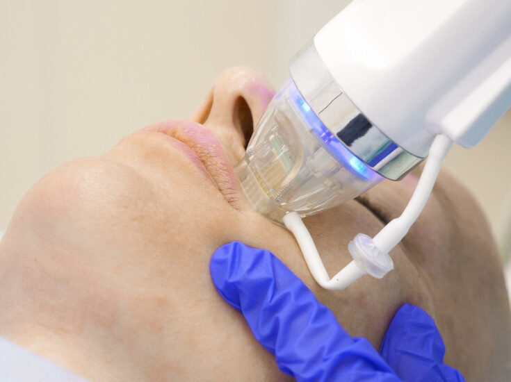 rf microneedling yeg