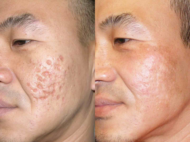 rf microneedling