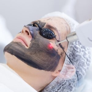 Hollywood Laser Carbon Facial Peel — Face, Neck & Hands